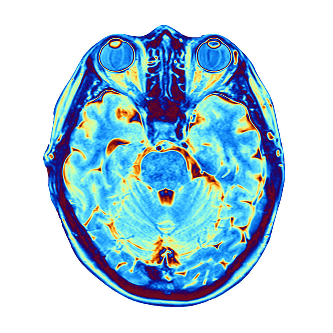 Cerebrolysin: The Anti-Inflammatory Effect ozone peptide therapy eb02 regenerative clinics holistic health care naturopath naturopathy medicine biohacking london